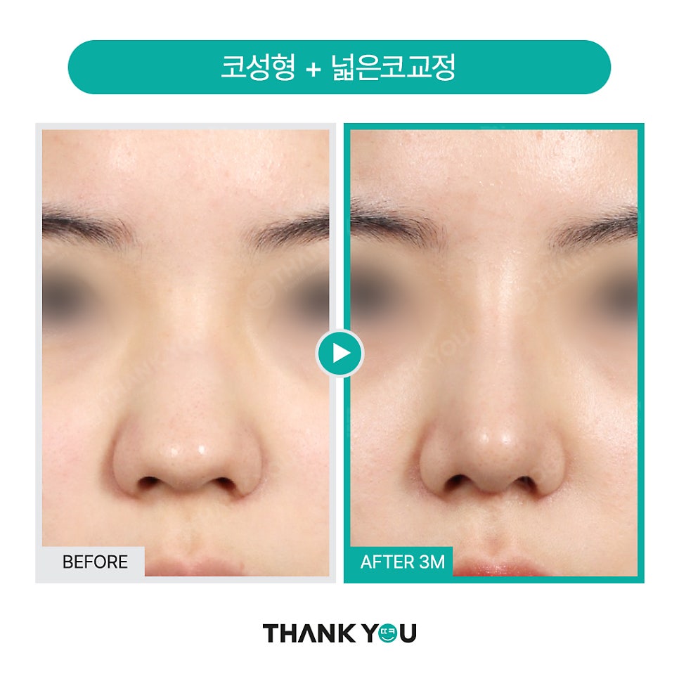 넓은코, 큰코성형 매부리코교정 찾는다면? 관련 이미지 2