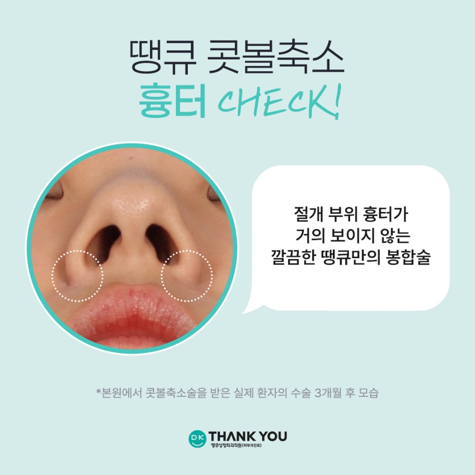 콧볼성형 찾는다면 여기! 땡큐 콧볼축소로 세련된 이미지 완성하기! 관련 이미지 6