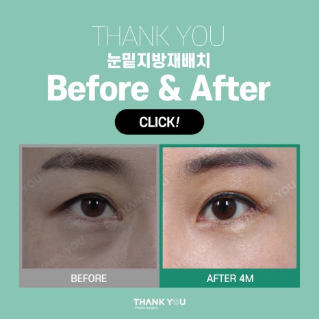 눈밑지 눈밑지방제거, 하안검 차이점은? (눈밑 비포&애프터) 관련 이미지 11