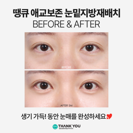 눈밑지전후 애교살에 변화가 생길까? [김다솜 원장 칼럼] 관련 이미지 8