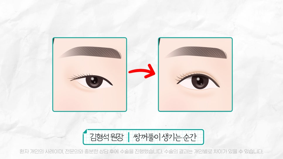 중년눈성형 전후& 이마거상+눈썹하거상+쌍수로 젊어지기 관련 이미지 18