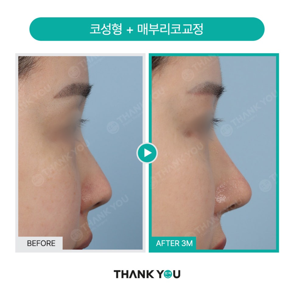 코성형 아직도 L자보형물? 실리콘 선택 기준은? 관련 이미지 8