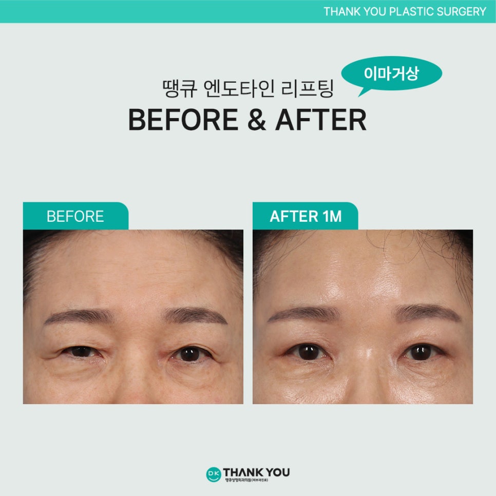 Endotine Lifting: If You Want Better Results?! image 12