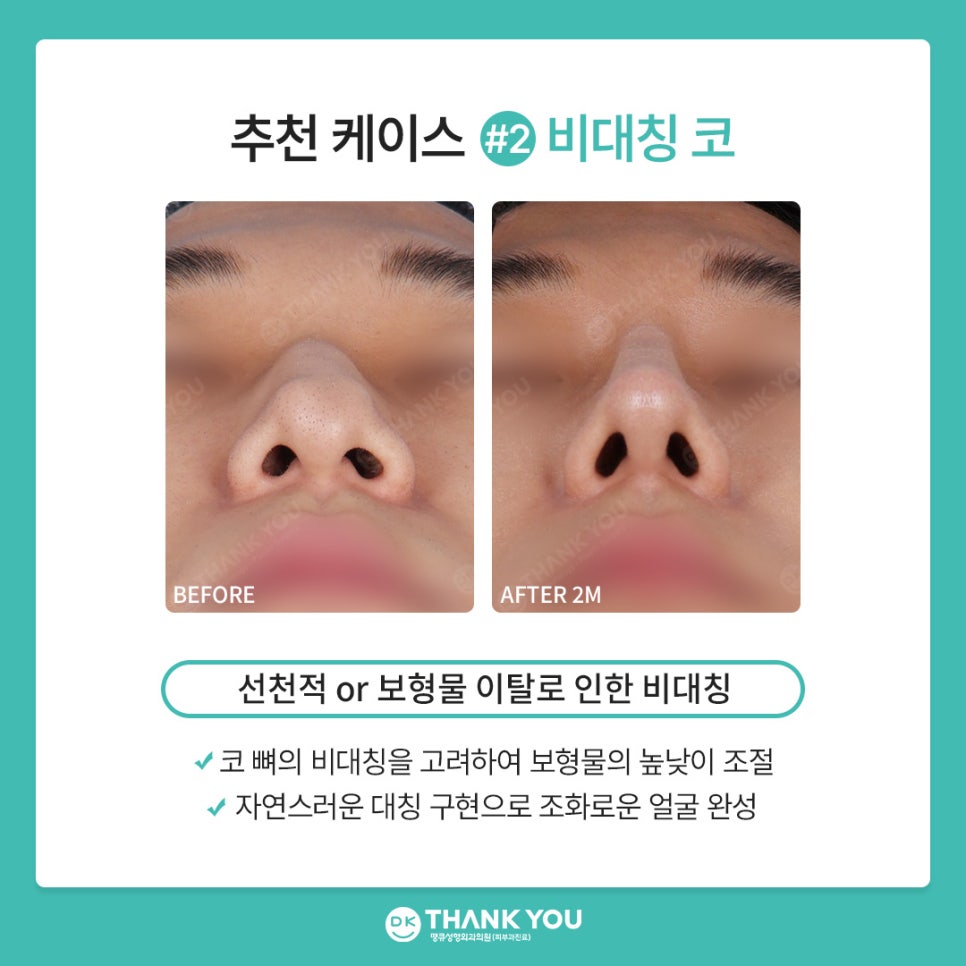 땡큐성형외과 권정우 원장, 코수술재료 관련 이미지 7