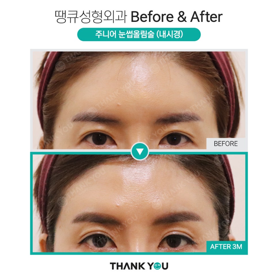 나이가 어린데도 이마거상을 꼭 해야 할까요? 관련 이미지 6