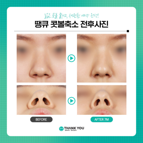 콧볼축소술로 촌스러운 이미지 만드는 콧볼줄이기! 관련 이미지 7