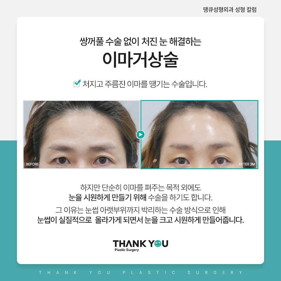 쌍꺼풀수술 없이 처진 눈 해결? [중년 이마거상/ 눈썹하거상술] 관련 이미지 3