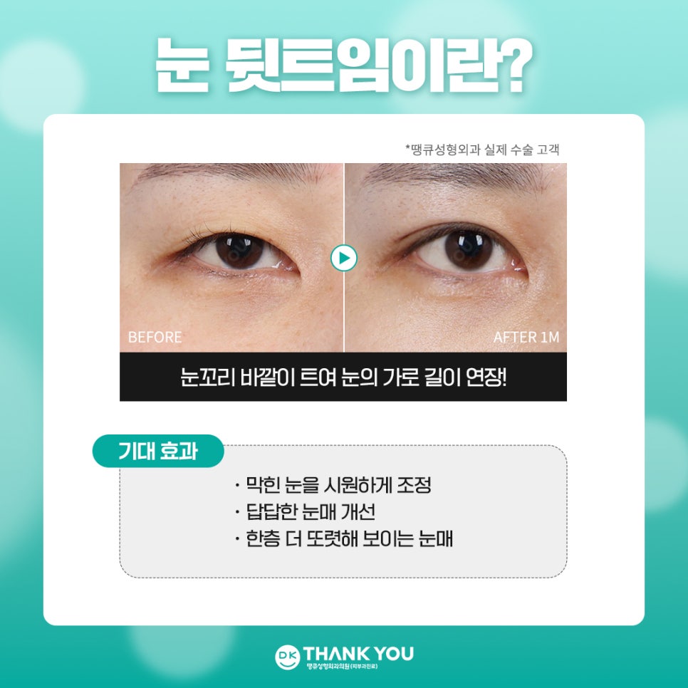 눈트임수술 [땡큐 팝콘트임]으로 듀얼트임 효과내기✨ 관련 이미지 4