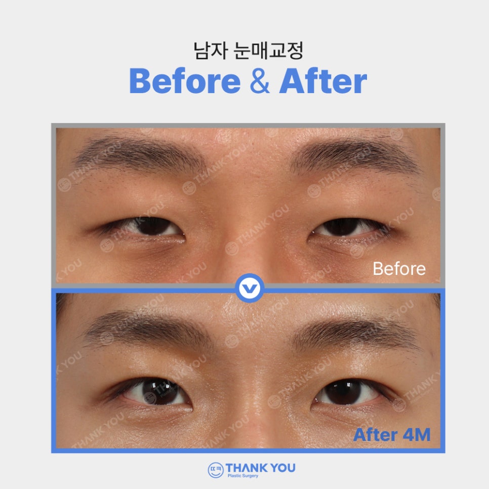 안검하수에 필요한 눈매교정 (ft.전후사진 체크) 관련 이미지 7