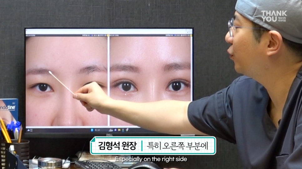 쌍수에 눈썹올림술을 추천하는 이유?! 관련 이미지 7