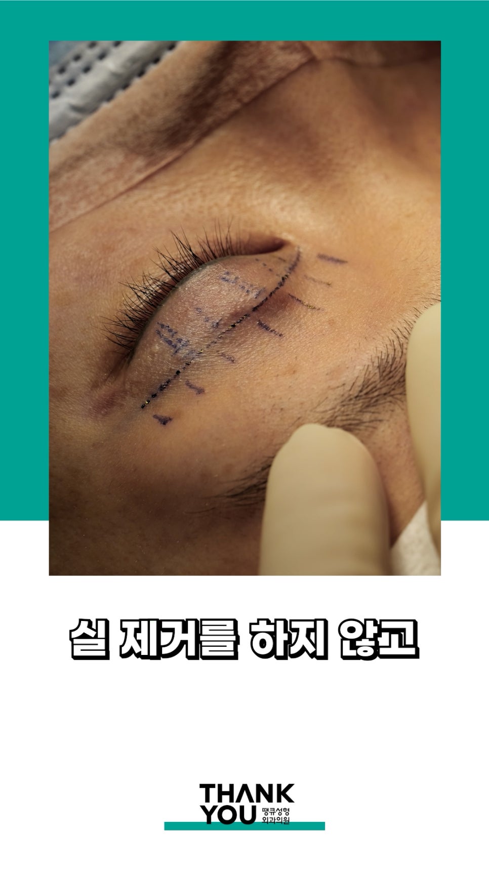 3번 눈재수술? 근데 실제거를 안했다고? 땡큐에서 전부 실제거! 관련 이미지 5