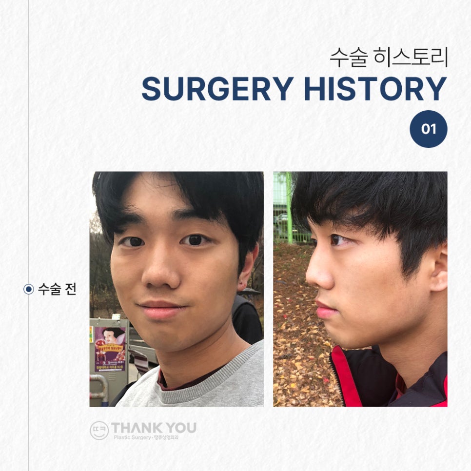 남자코성형후기, 코절골술로 매부리코를 매끈하게 관련 이미지 4