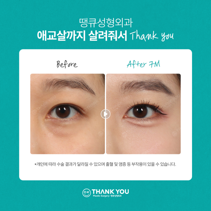 눈밑지방재배치잘하는곳은 이렇게 합니다✨✨ 관련 이미지 9