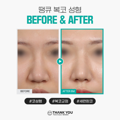 복코성형, 꼭 코뼈절골을 해야할까요? 관련 이미지 6