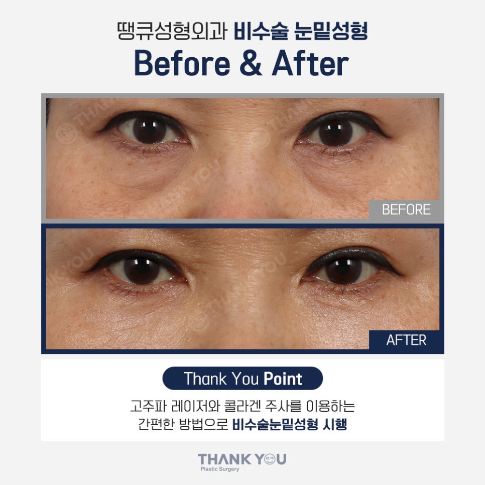 비수술 눈밑성형, 레이저 눈밑지방재배치란? 관련 이미지 7