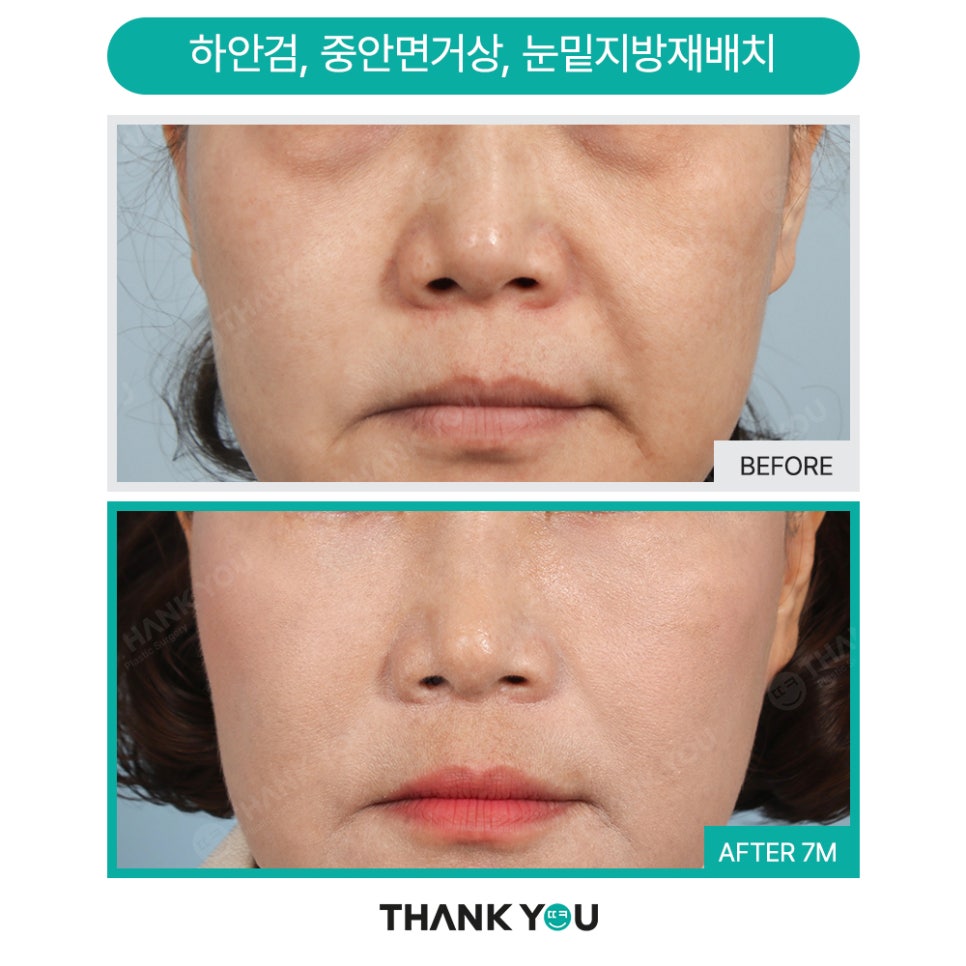 눈밑지방재배치 함께 필요한 미세 지방이식?(땡큐 나노펫) 관련 이미지 8