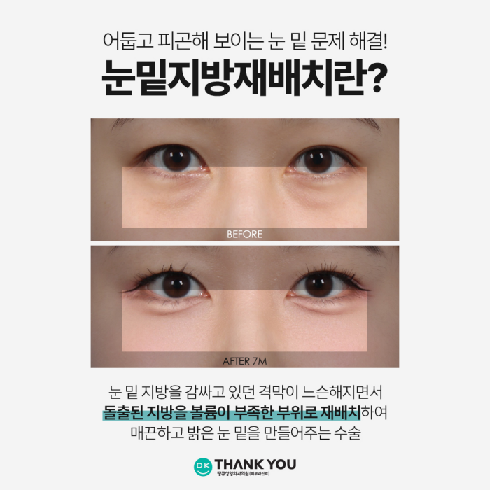 눈밑지전후 애교살에 변화가 생길까? [김다솜 원장 칼럼] 관련 이미지 2