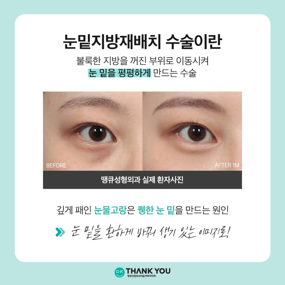 Still Hollow Under the Eyes After Lower Eyelid Fat Repositioning? The Need for Microfat Grafting Under the Eyes image 2