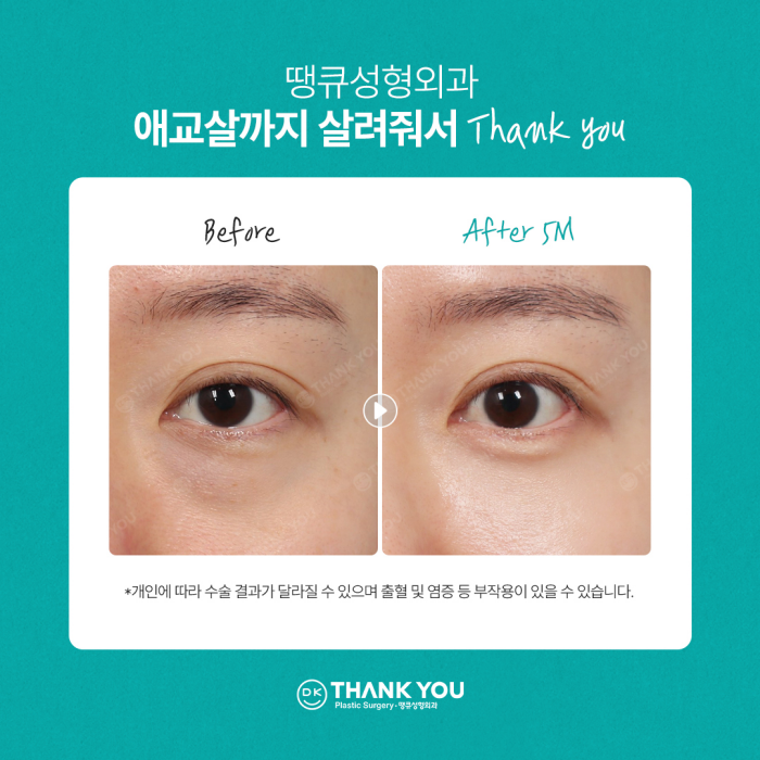 눈밑지방재배치잘하는곳은 이렇게 합니다✨✨ 관련 이미지 8
