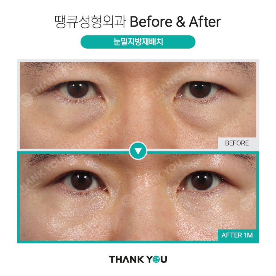 눈밑 필러 넣었는데 눈밑지방재배치 가능할까요? (이호준 칼럼) 관련 이미지 18