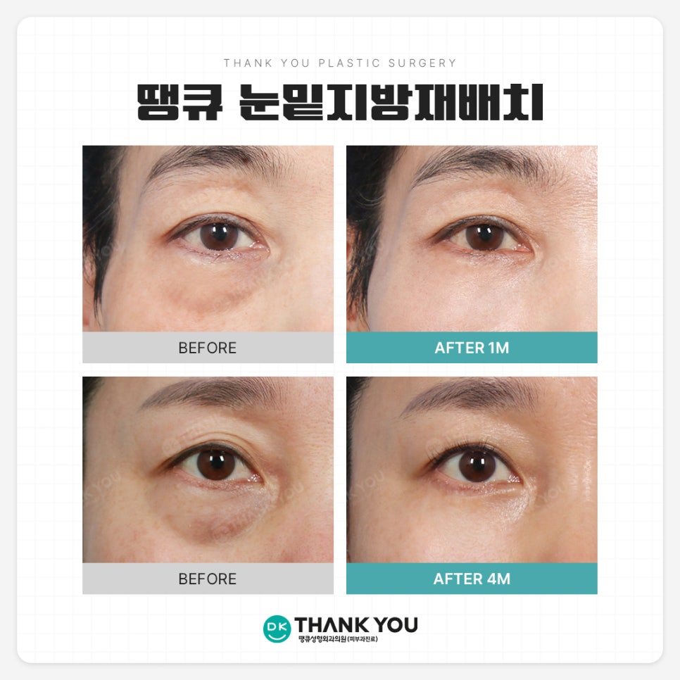 눈밑지방재배치 사시?! 눈밑지 사시는 왜 생길까 관련 이미지 10