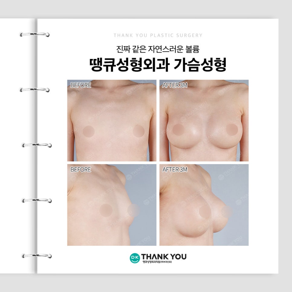 가슴성형전후 만큼 중요한 보형물 선택! 종류별 특징? 관련 이미지 11