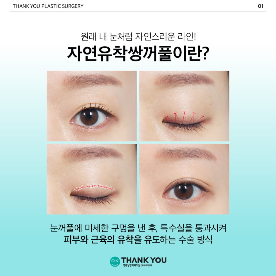 Natural Adhesion Double Eyelids: If You Want Naturalness That Lasts Longer image 2