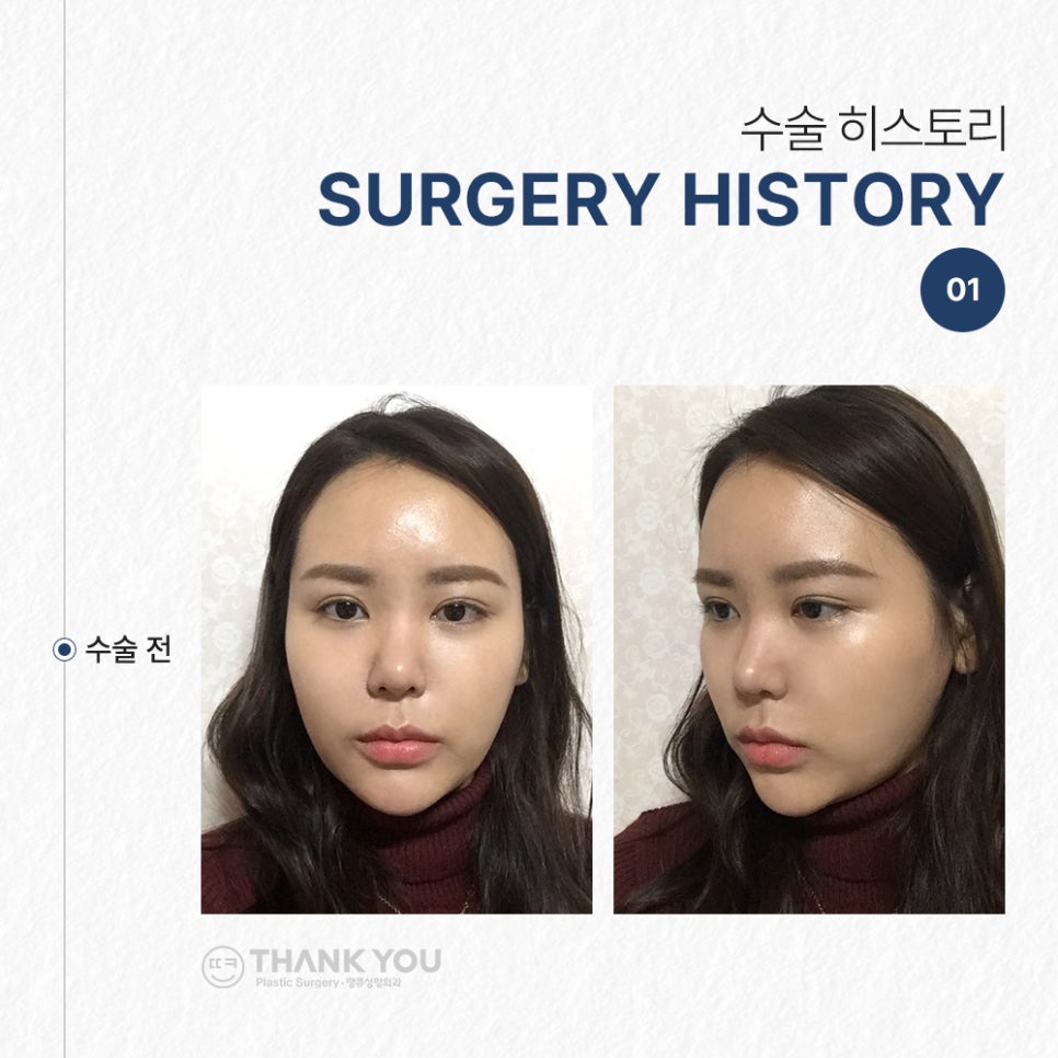 코필러 대신 여자코성형 (콧대+코끝)자연스럽게 관련 이미지 4