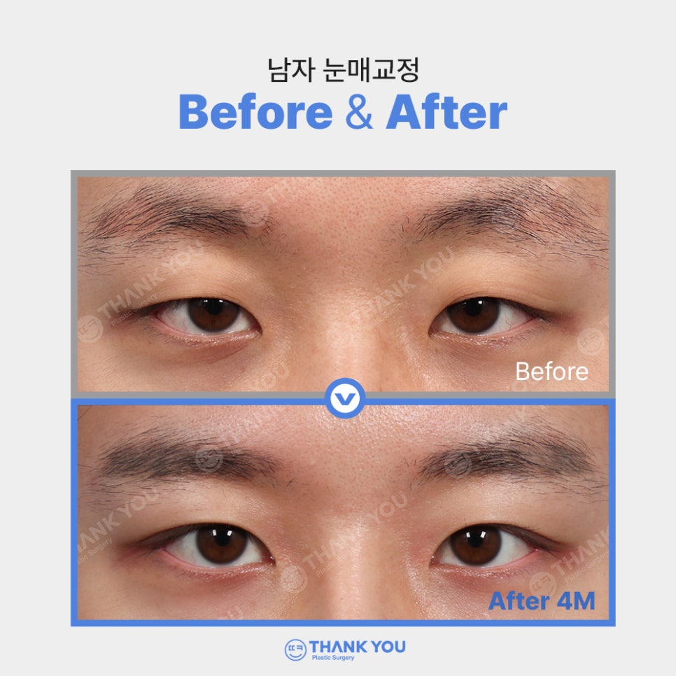 안검하수에 필요한 눈매교정 (ft.전후사진 체크) 관련 이미지 9