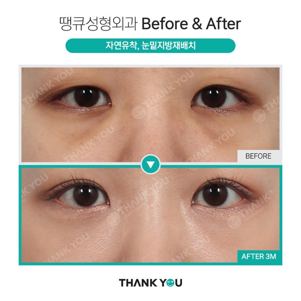 눈밑지 지방이식? 앞광대지방이식 필요한 이유? 관련 이미지 14