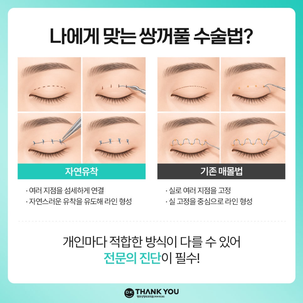자연유착쌍꺼풀 후기 좋은 곳 땡큐에서 예뻐질 시간💖 관련 이미지 3