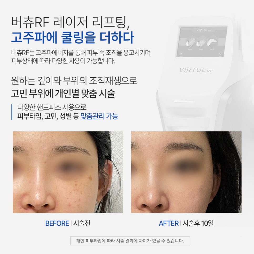 버츄RF 레이저 리프팅✨ 땡큐피부과 EVENT 관련 이미지 2