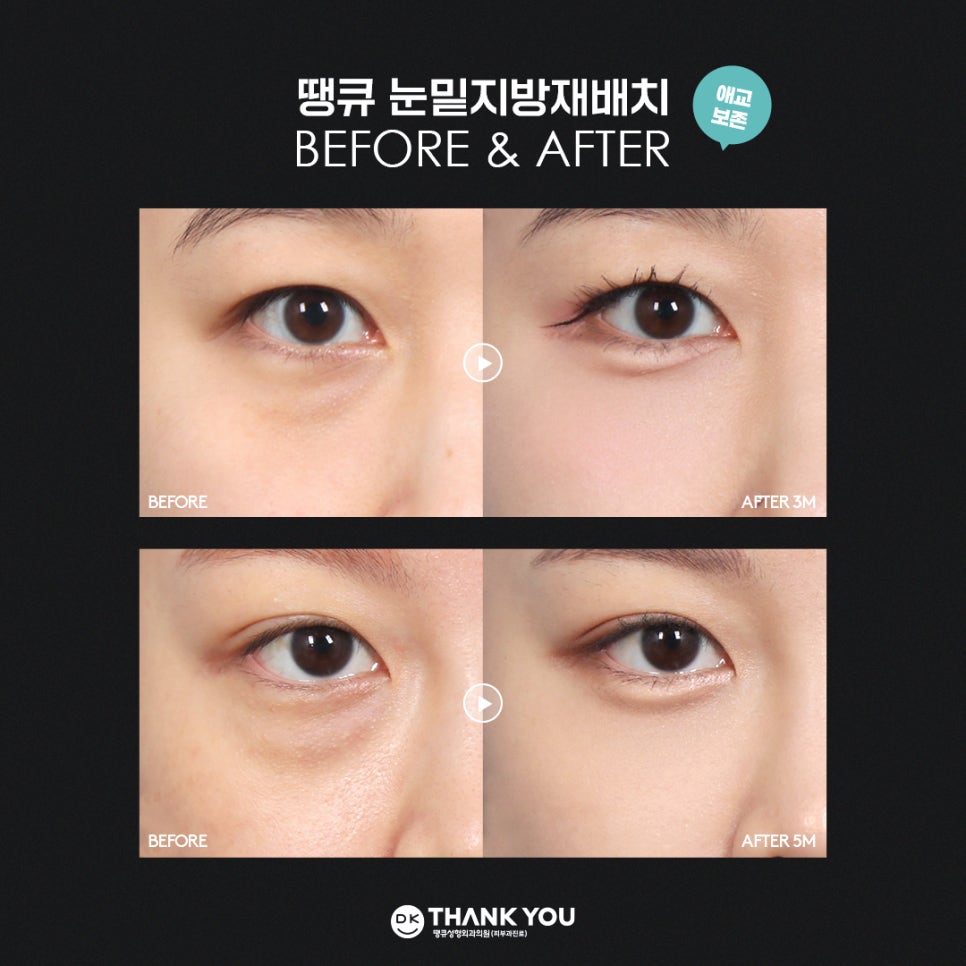 눈밑지방재배치잘하는병원 땡큐만의 특별한 노하우! 관련 이미지 9