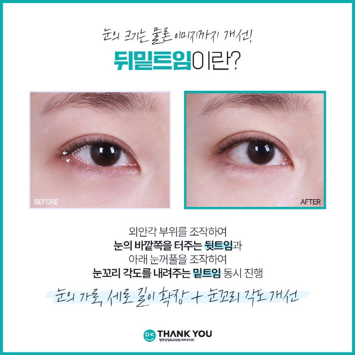 뒤밑트임 수술로 눈의 크기는 물론 이미지 개선까지! 관련 이미지 3
