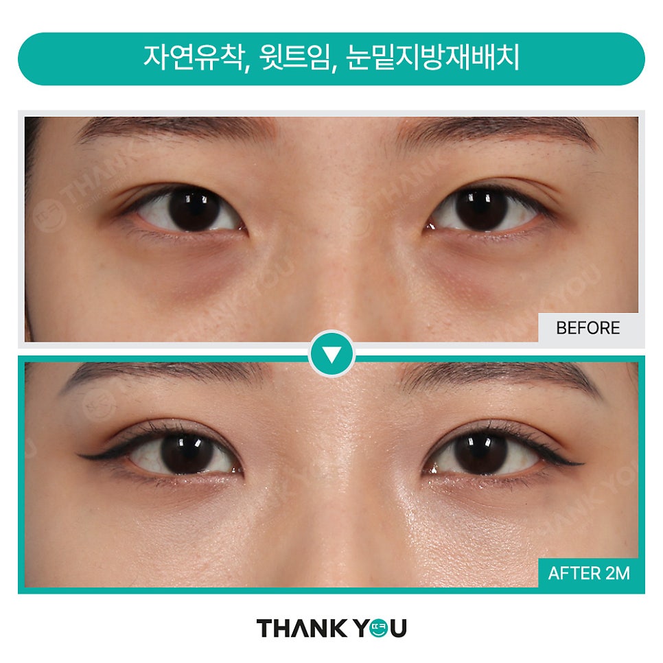 가로로 긴 눈은 어떤 쌍꺼풀라인이 어울릴까요? 관련 이미지 13