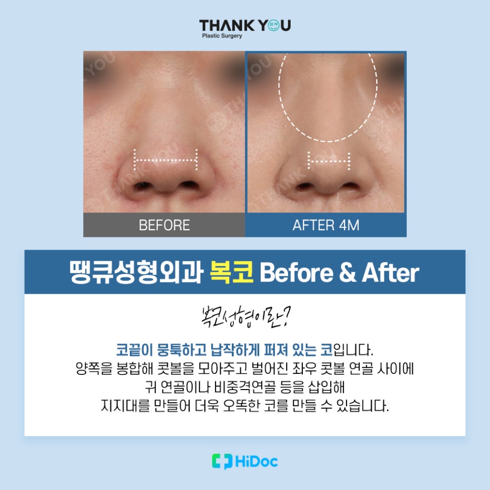 코성형 종류, 보형물과 콧대 라인까지 니즈 체크 관련 이미지 7