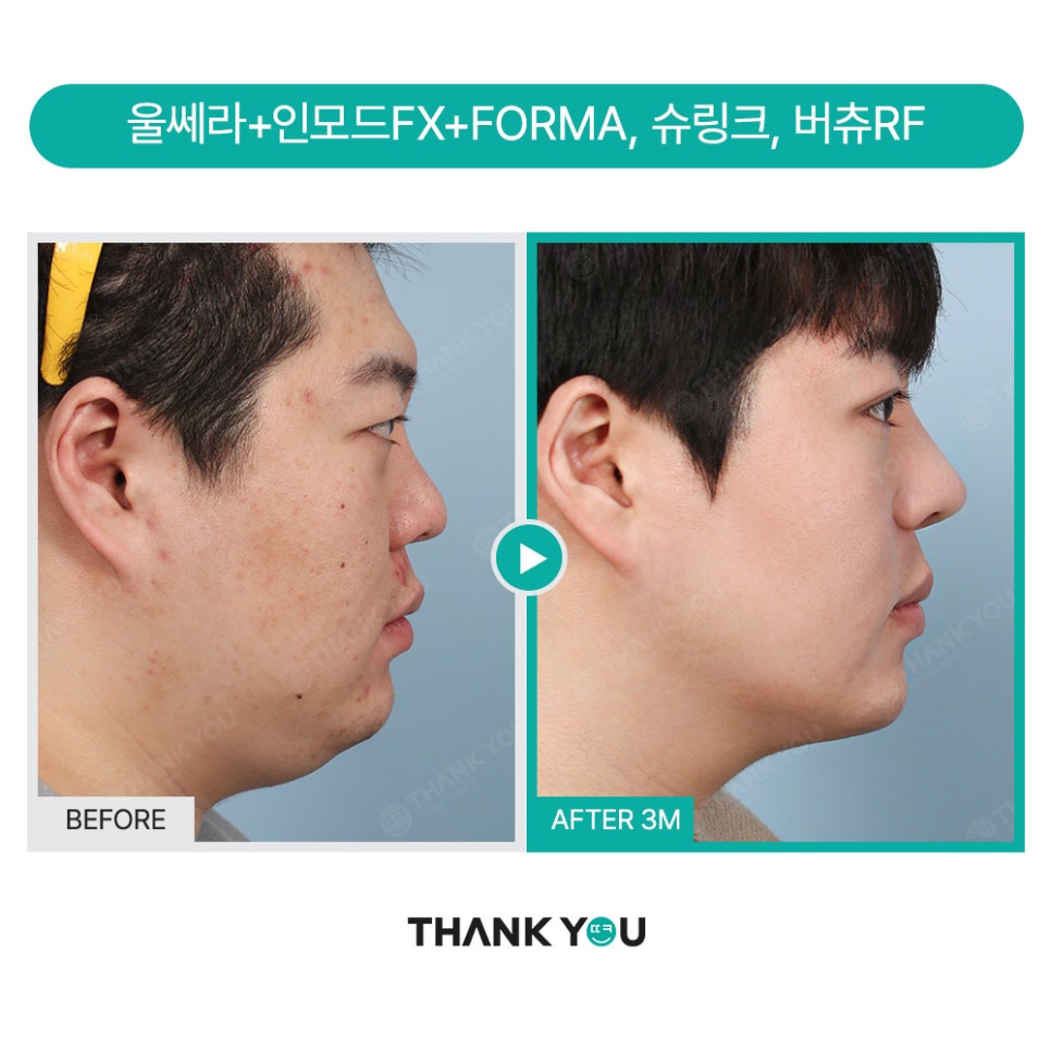 땡큐 맥미남, 뮤지컬배우 남자 복부지방흡입 전후 Check 관련 이미지 18