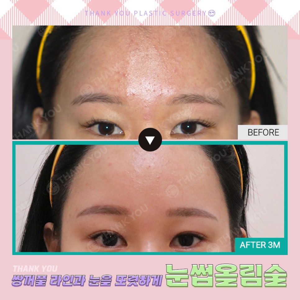 쌍수에 눈썹올림술을 추천하는 이유?! 관련 이미지 22