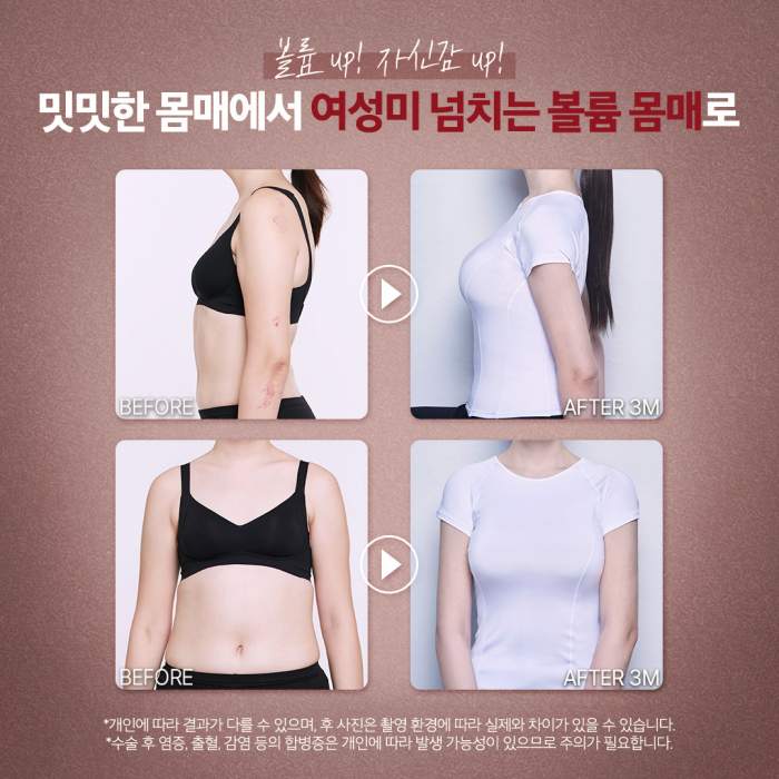 Creating a Perfectly Fitted Chest to Match Your Body Type at a Hospital That Excels at Breast Surgery😊 image 6