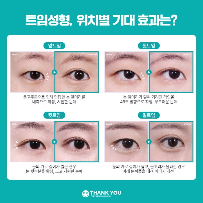 뒤밑트임 수술로 눈의 크기는 물론 이미지 개선까지! 관련 이미지 2