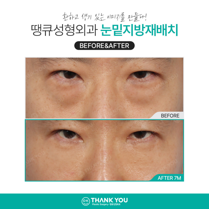 눈밑지방재배치병원에서 알려주는 수술이 필요한 케이스 관련 이미지 7