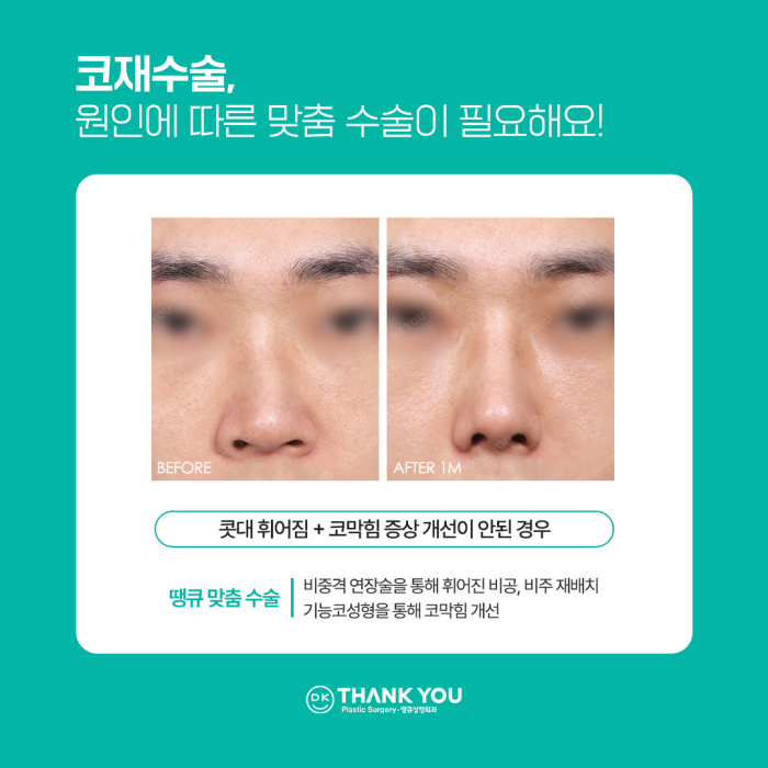 코재수술병원에서 알려주는 재수술하게 되는 이유! 관련 이미지 5
