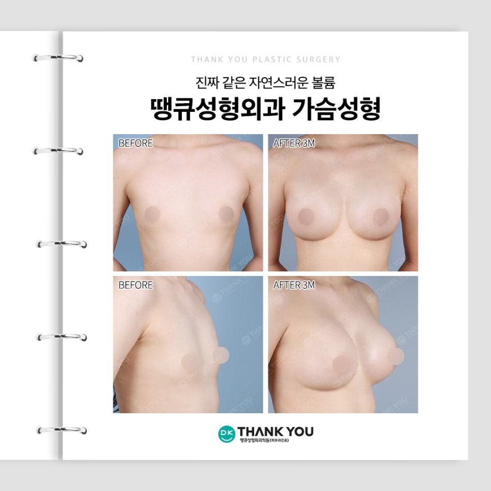 가슴성형전후 만큼 중요한 보형물 선택! 종류별 특징? 관련 이미지 10