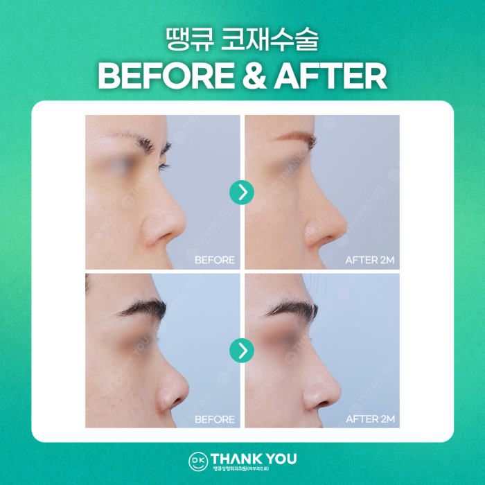 코재수술잘하는곳, 신중하게 선택해야 하는 이유는? 관련 이미지 8