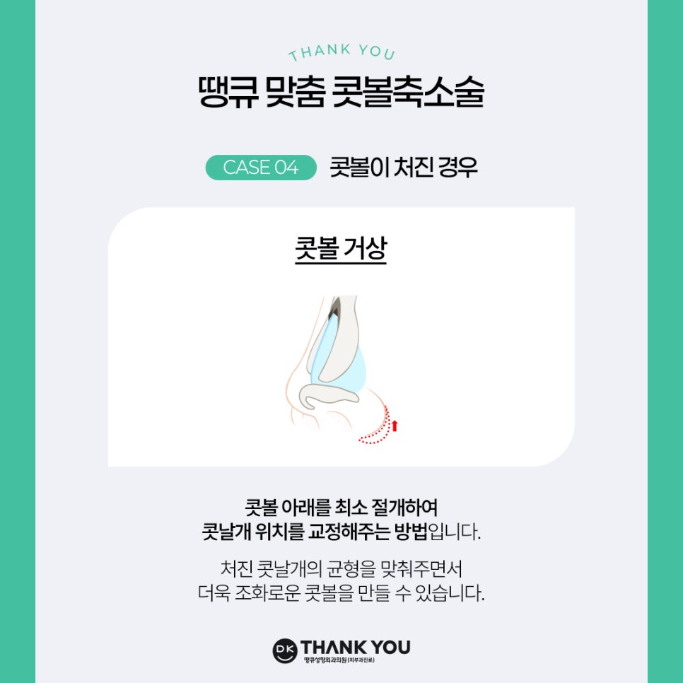 콧볼축소술, 케이스에 따른 맞춤 수술 방법은? 관련 이미지 7