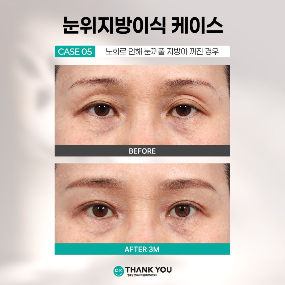 눈꺼풀꺼짐 개선하려면? 꺼진눈지방이식 전에 알아야 할 3가지 관련 이미지 8