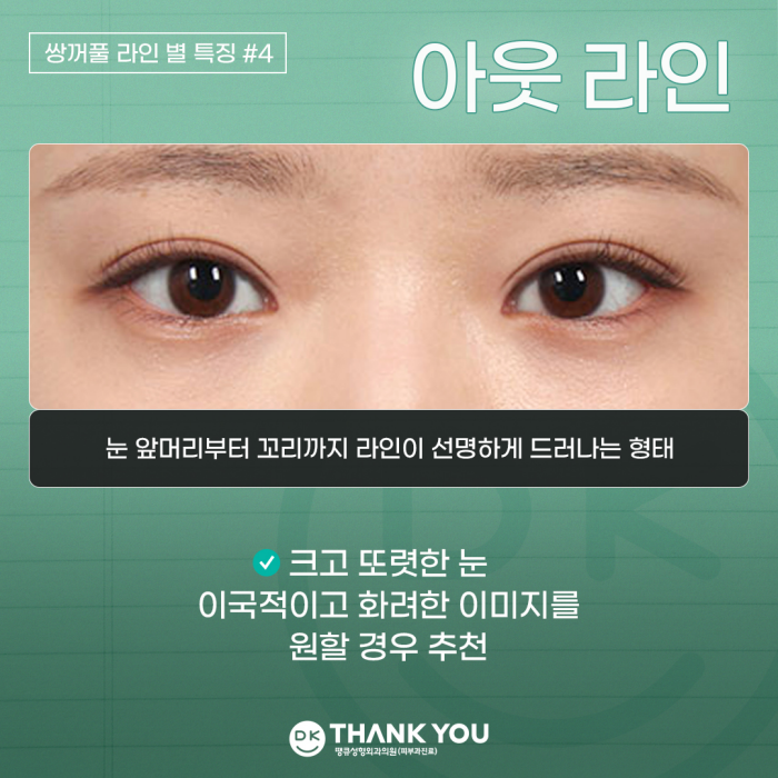 Double-Eyelid Surgery Line: Which One Suits Me Best? image 6