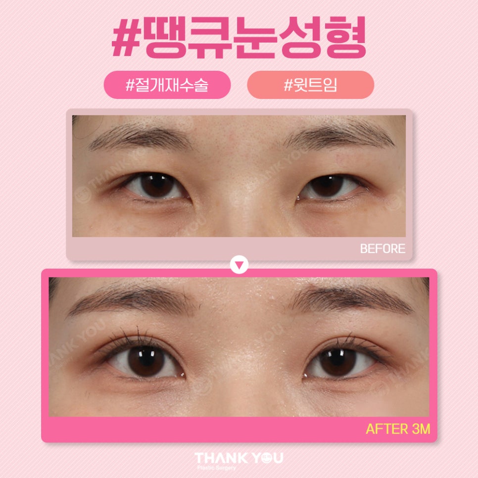 땡큐 쌍꺼풀 전후사진 비교 Before & After 관련 이미지 8