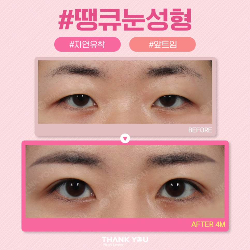 땡큐 쌍꺼풀 전후사진 비교 Before & After 관련 이미지 2
