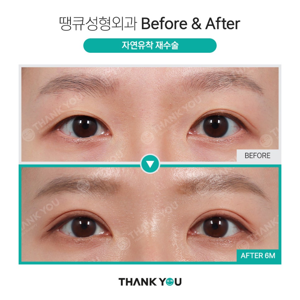 쌍수 풀기 (재수술전 실풀기+ 눈재수술 전후) 관련 이미지 15